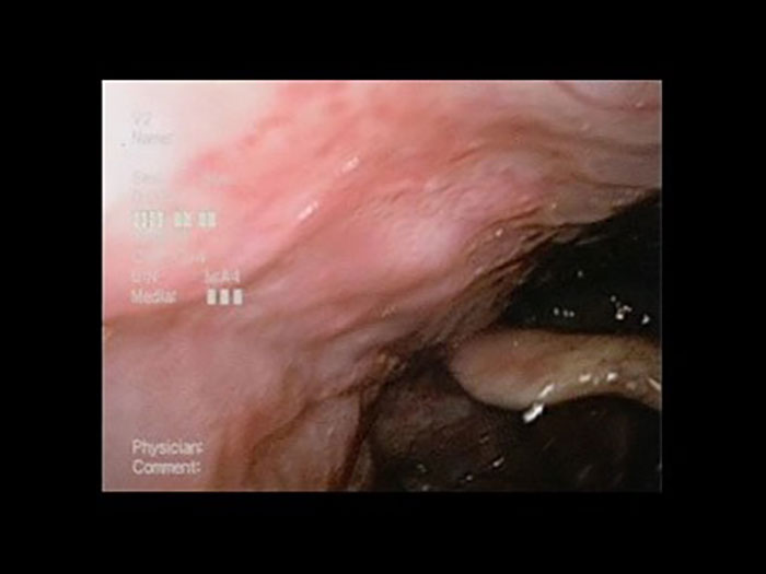 ＜中咽頭癌（口蓋垂－右軟口蓋）＞通常光