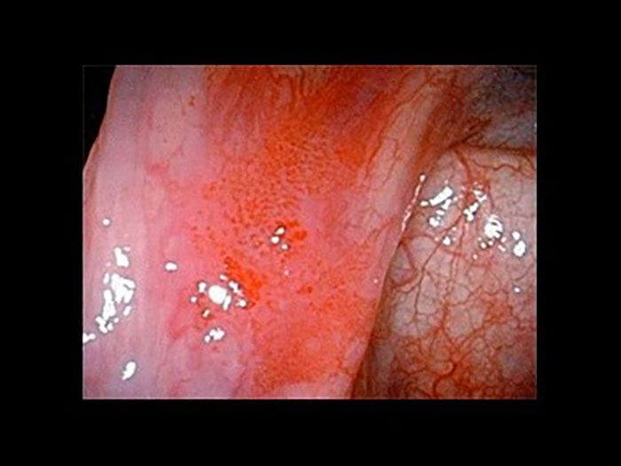 下咽頭癌（右梨状陥凹）通常光