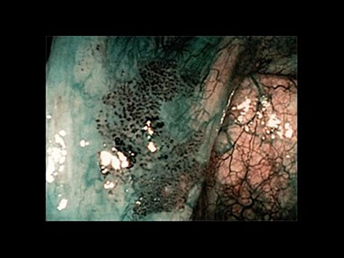 下咽頭癌（右梨状陥凹）NBI